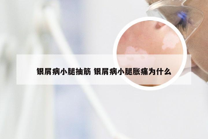 银屑病小腿抽筋 银屑病小腿胀痛为什么