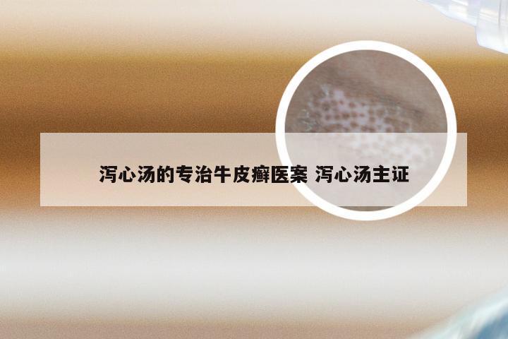 泻心汤的专治牛皮癣医案 泻心汤主证