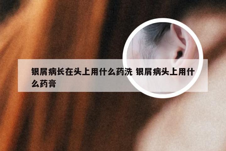 银屑病长在头上用什么药洗 银屑病头上用什么药膏