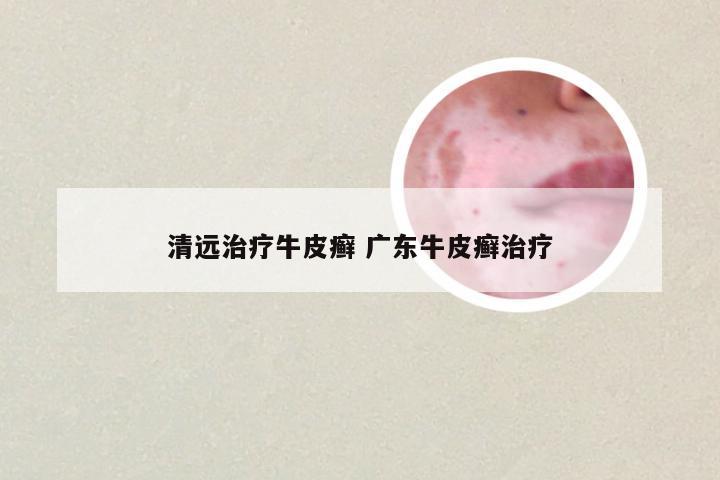 清远治疗牛皮癣 广东牛皮癣治疗