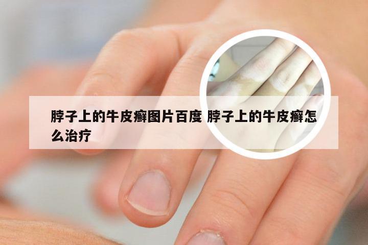 脖子上的牛皮癣图片百度 脖子上的牛皮癣怎么治疗