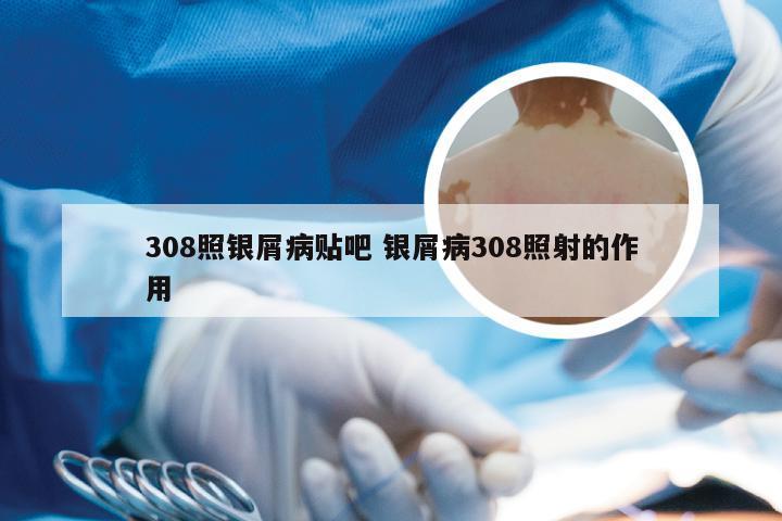 308照银屑病贴吧 银屑病308照射的作用