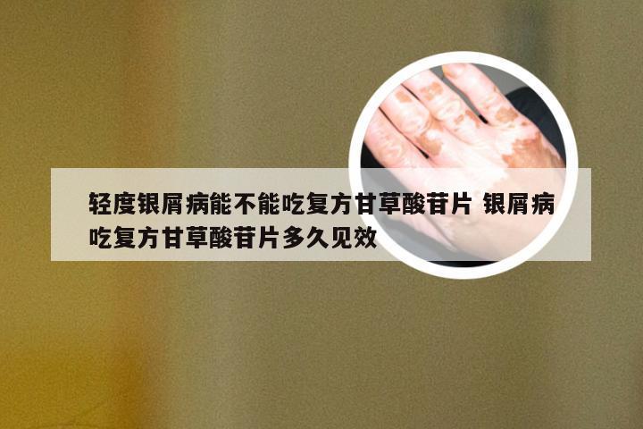 轻度银屑病能不能吃复方甘草酸苷片 银屑病吃复方甘草酸苷片多久见效