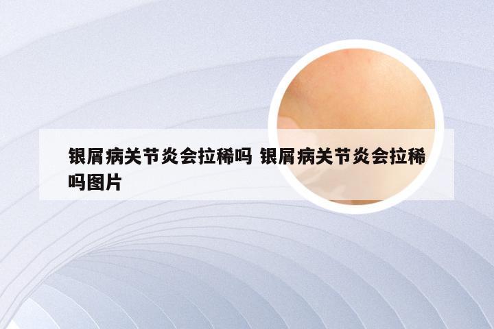 银屑病关节炎会拉稀吗 银屑病关节炎会拉稀吗图片