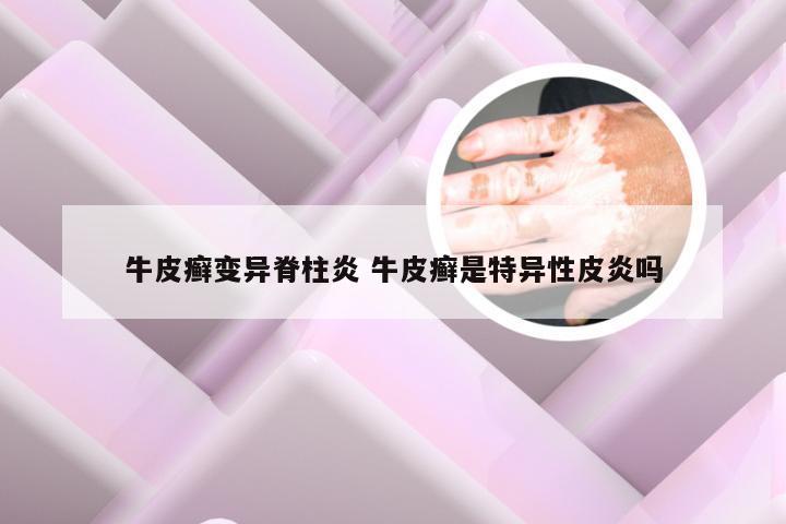 牛皮癣变异脊柱炎 牛皮癣是特异性皮炎吗