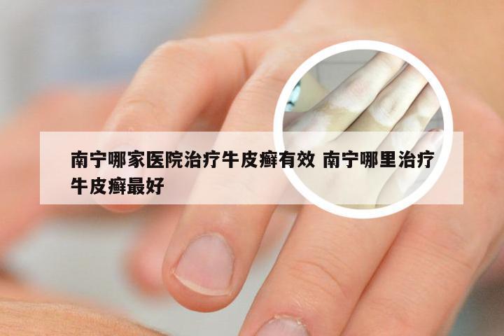 南宁哪家医院治疗牛皮癣有效 南宁哪里治疗牛皮癣最好
