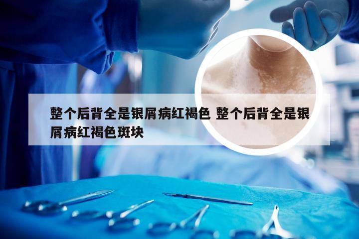 整个后背全是银屑病红褐色 整个后背全是银屑病红褐色斑块