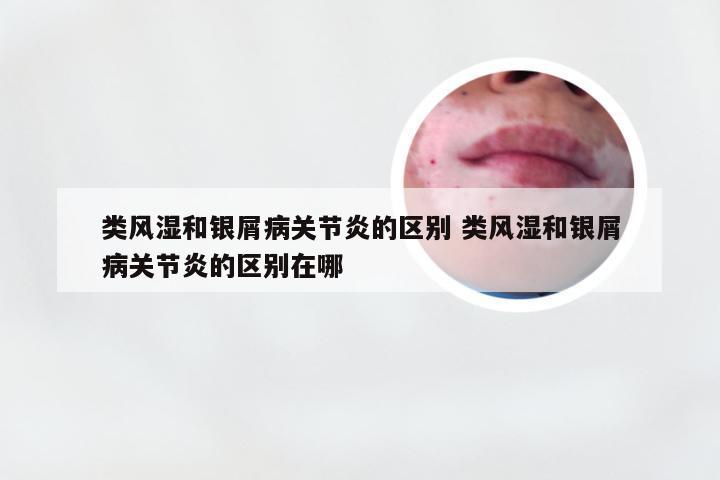 类风湿和银屑病关节炎的区别 类风湿和银屑病关节炎的区别在哪