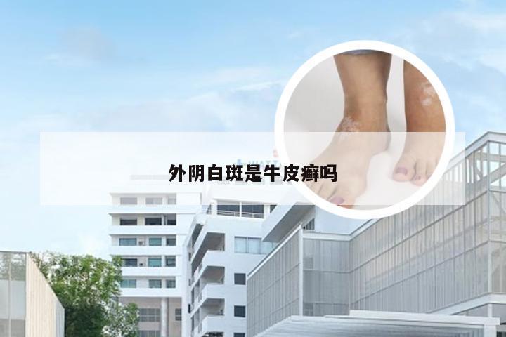 外阴白斑是牛皮癣吗
