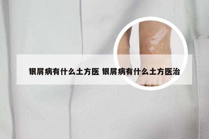 银屑病有什么土方医 银屑病有什么土方医治