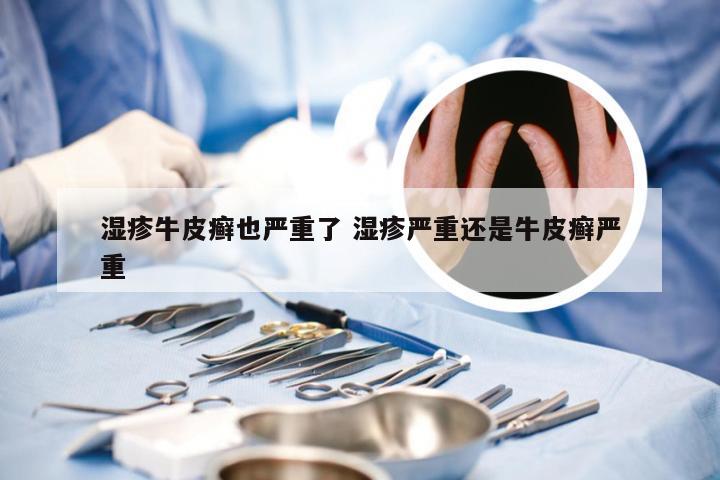 湿疹牛皮癣也严重了 湿疹严重还是牛皮癣严重