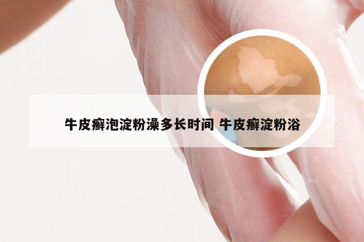 牛皮癣泡淀粉澡多长时间 牛皮癣淀粉浴