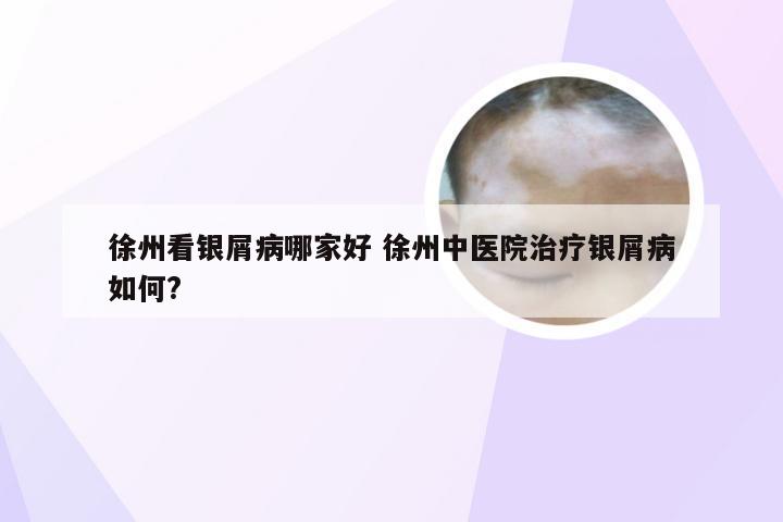 徐州看银屑病哪家好 徐州中医院治疗银屑病如何?