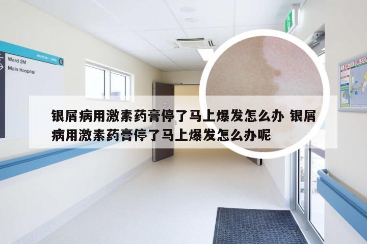 银屑病用激素药膏停了马上爆发怎么办 银屑病用激素药膏停了马上爆发怎么办呢