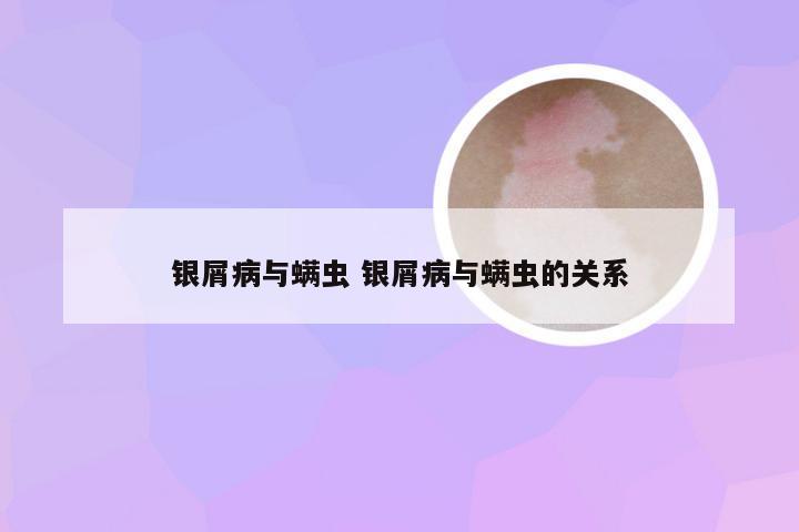 银屑病与螨虫 银屑病与螨虫的关系
