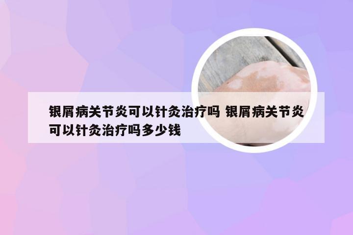 银屑病关节炎可以针灸治疗吗 银屑病关节炎可以针灸治疗吗多少钱