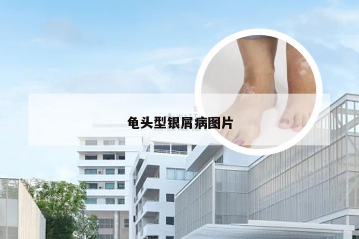 龟头型银屑病图片