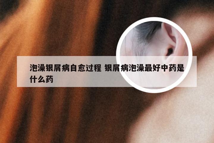 泡澡银屑病自愈过程 银屑病泡澡最好中药是什么药
