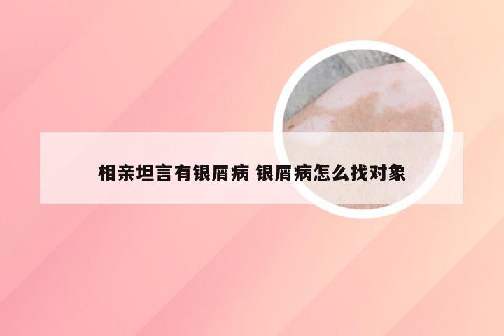 相亲坦言有银屑病 银屑病怎么找对象