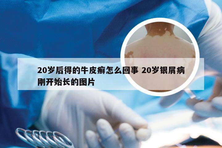 20岁后得的牛皮癣怎么回事 20岁银屑病刚开始长的图片