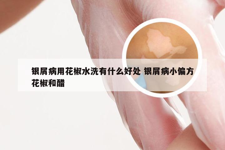 银屑病用花椒水洗有什么好处 银屑病小偏方花椒和醋