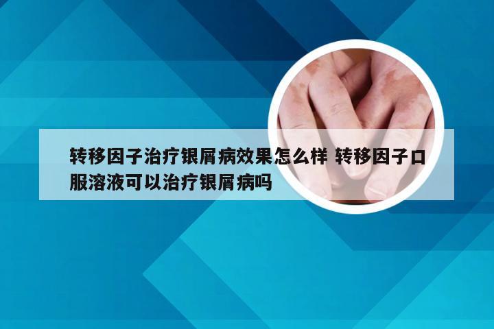 转移因子治疗银屑病效果怎么样 转移因子口服溶液可以治疗银屑病吗