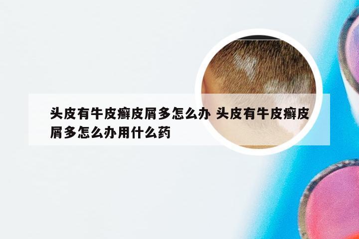 头皮有牛皮癣皮屑多怎么办 头皮有牛皮癣皮屑多怎么办用什么药