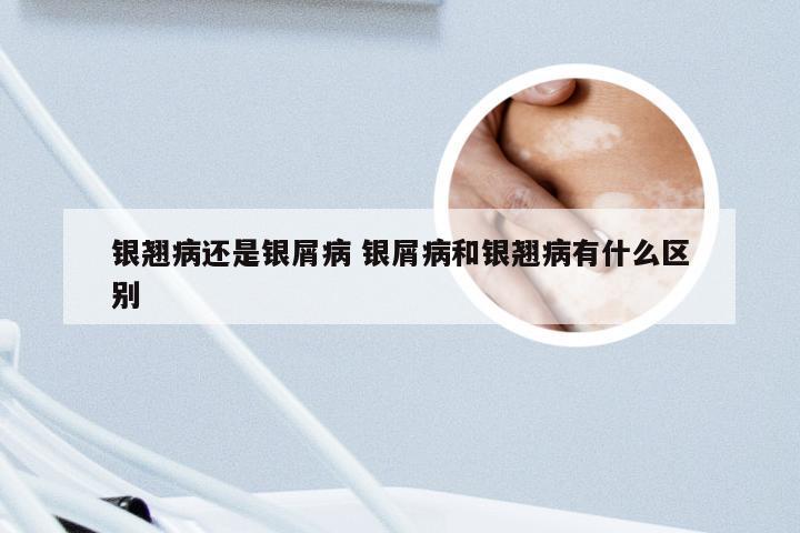 银翘病还是银屑病 银屑病和银翘病有什么区别
