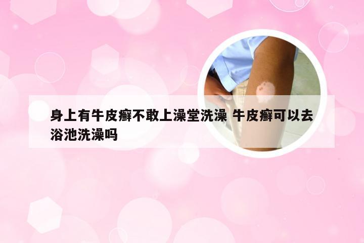 身上有牛皮癣不敢上澡堂洗澡 牛皮癣可以去浴池洗澡吗
