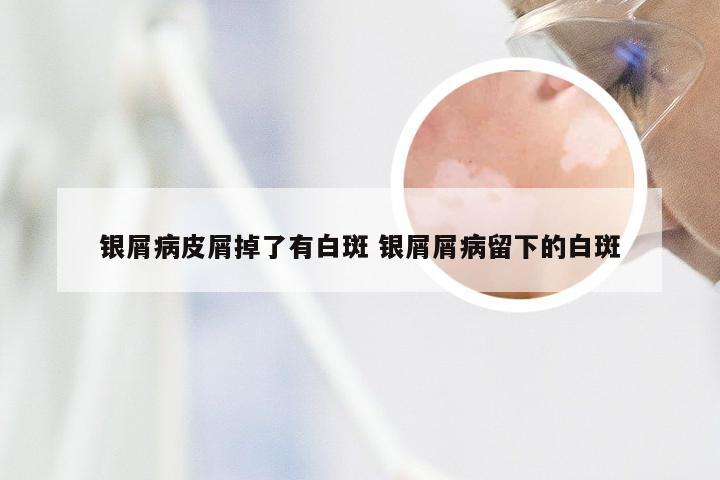 银屑病皮屑掉了有白斑 银屑屑病留下的白斑