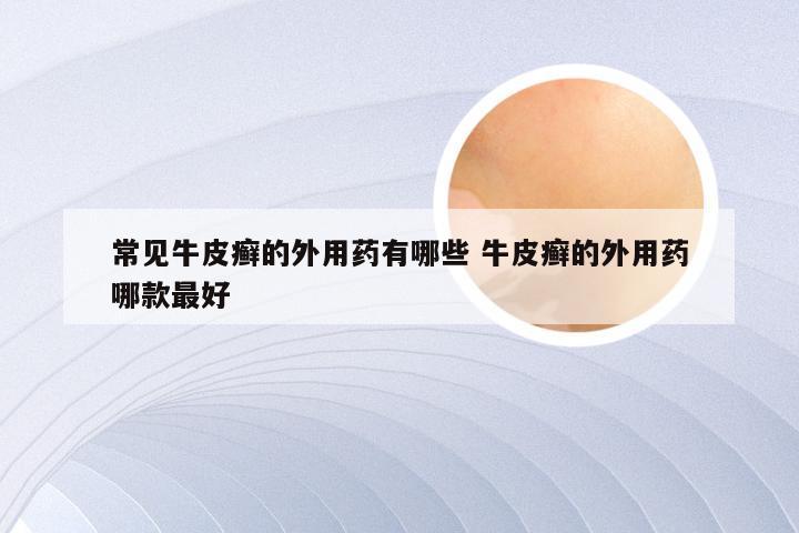 常见牛皮癣的外用药有哪些 牛皮癣的外用药哪款最好