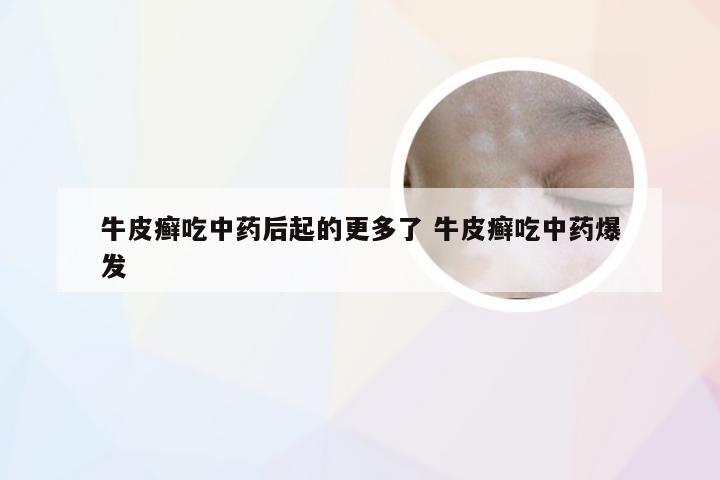 牛皮癣吃中药后起的更多了 牛皮癣吃中药爆发