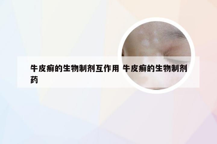 牛皮癣的生物制剂互作用 牛皮癣的生物制剂药