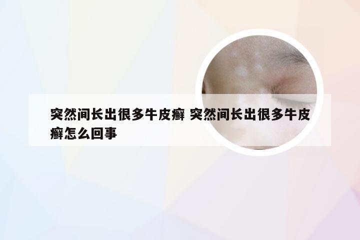 突然间长出很多牛皮癣 突然间长出很多牛皮癣怎么回事