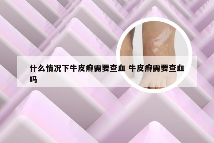什么情况下牛皮癣需要查血 牛皮癣需要查血吗