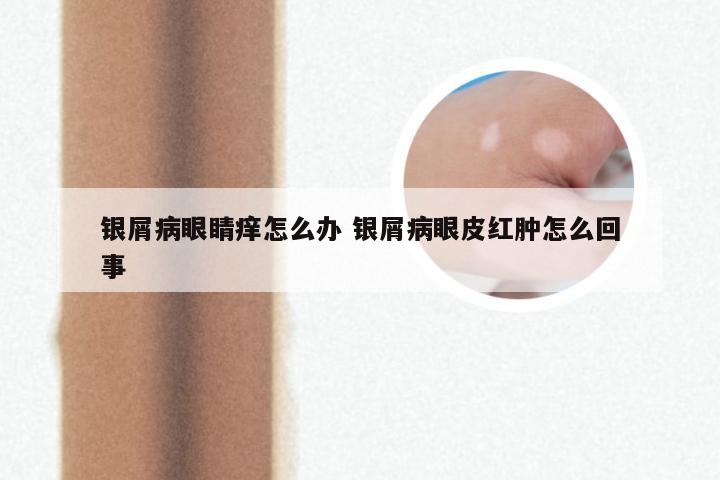 银屑病眼睛痒怎么办 银屑病眼皮红肿怎么回事