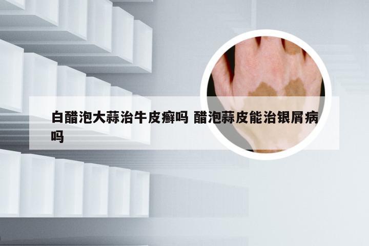 白醋泡大蒜治牛皮癣吗 醋泡蒜皮能治银屑病吗