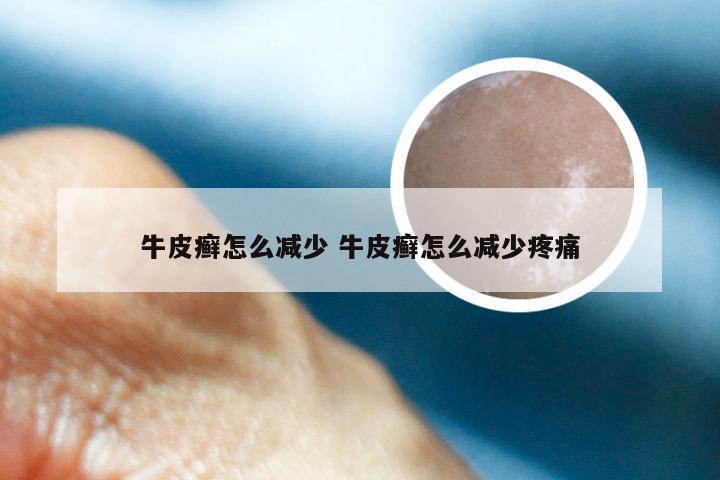 牛皮癣怎么减少 牛皮癣怎么减少疼痛