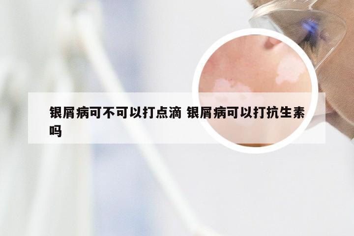 银屑病可不可以打点滴 银屑病可以打抗生素吗