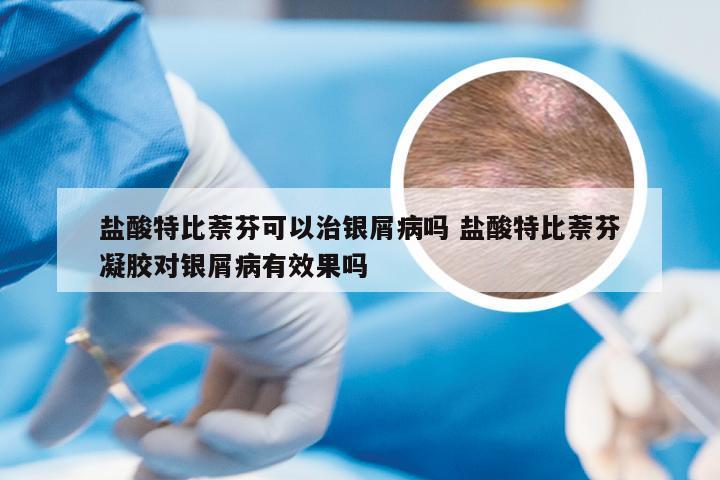 盐酸特比萘芬可以治银屑病吗 盐酸特比萘芬凝胶对银屑病有效果吗