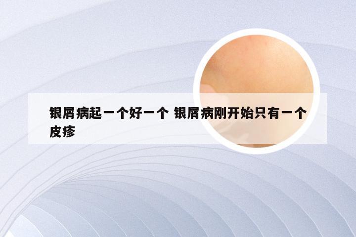 银屑病起一个好一个 银屑病刚开始只有一个皮疹