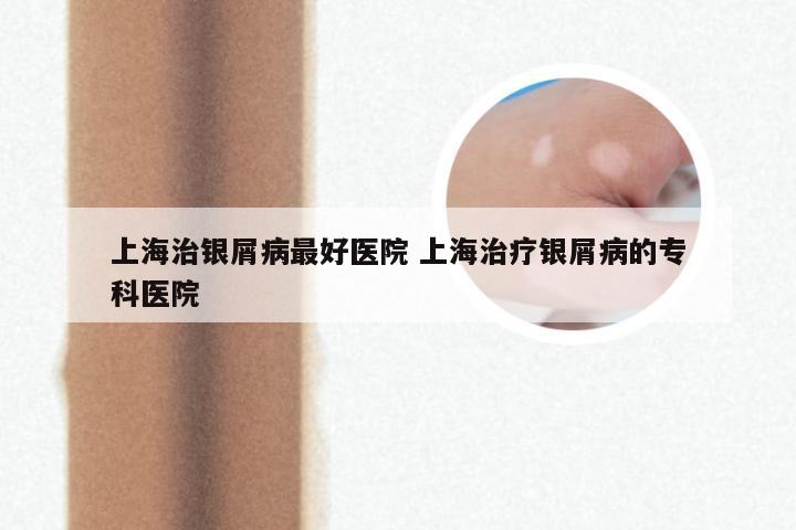 上海治银屑病最好医院 上海治疗银屑病的专科医院