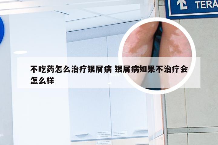 不吃药怎么治疗银屑病 银屑病如果不治疗会怎么样