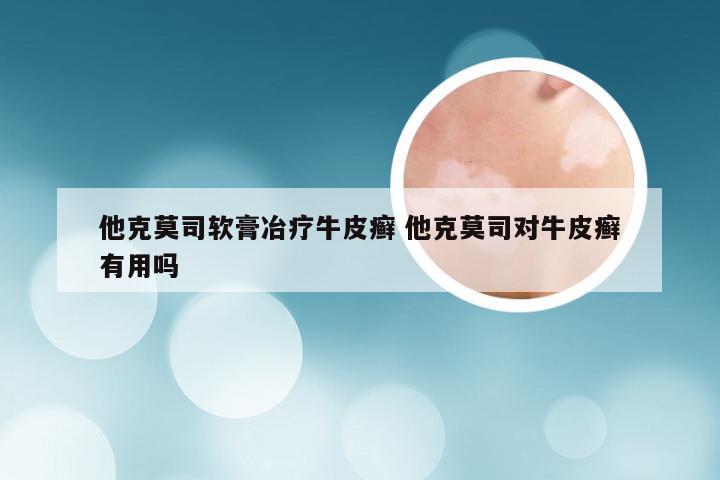 他克莫司软膏冶疗牛皮癣 他克莫司对牛皮癣有用吗