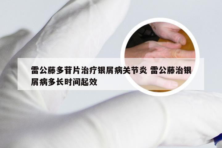 雷公藤多苷片治疗银屑病关节炎 雷公藤治银屑病多长时间起效