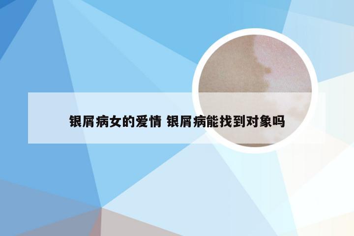 银屑病女的爱情 银屑病能找到对象吗