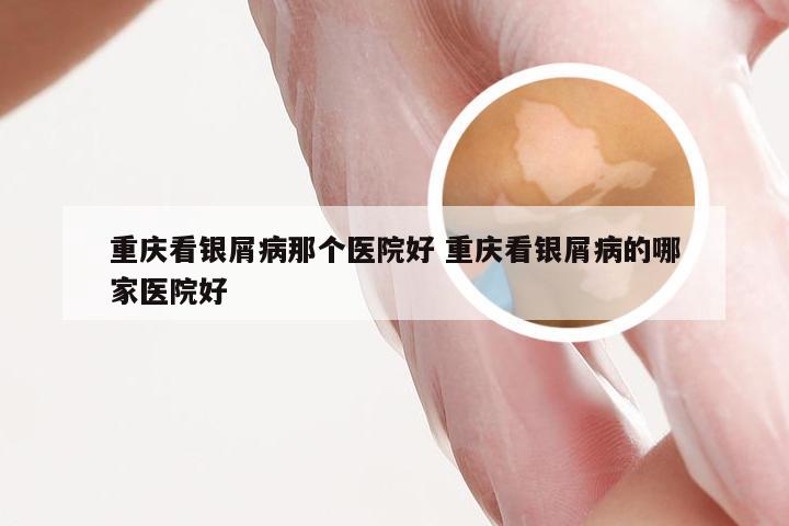 重庆看银屑病那个医院好 重庆看银屑病的哪家医院好