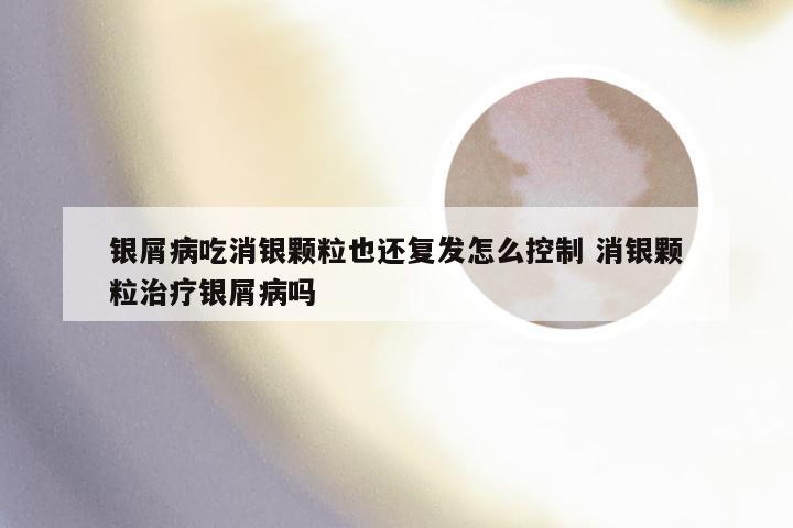 银屑病吃消银颗粒也还复发怎么控制 消银颗粒治疗银屑病吗