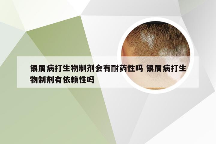 银屑病打生物制剂会有耐药性吗 银屑病打生物制剂有依赖性吗