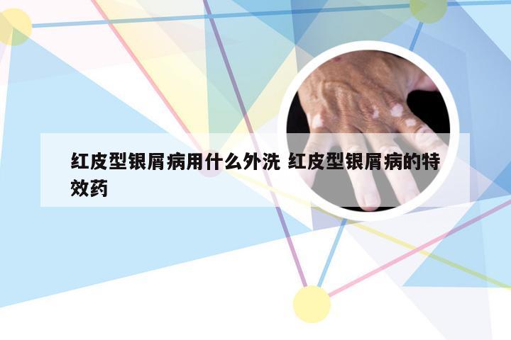 红皮型银屑病用什么外洗 红皮型银屑病的特效药